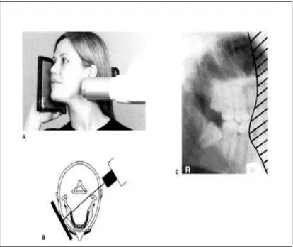 Gambar 4.   A. Posisi kaset dan tubehead  Sinar-X untuk molar kanan mandibula dan maksila B