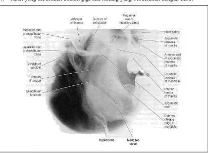 Gambar 8.  Gambaran anatomis ramus mandibula yang diidentifikasi dengan proyeksi lateral 