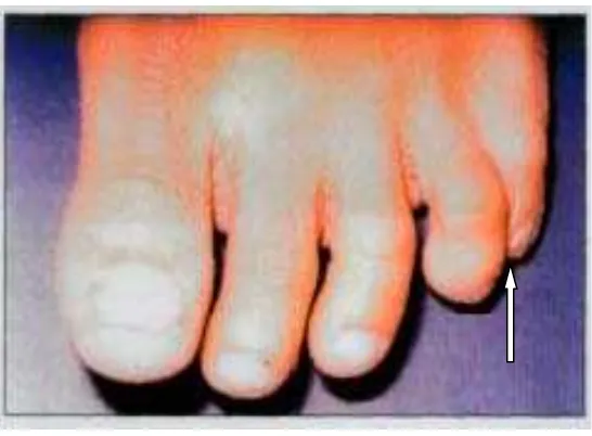 Gambar  1b.  Menunjukkan syndactyly dari jari  Ke4 dan ke5 kaki kiri.2