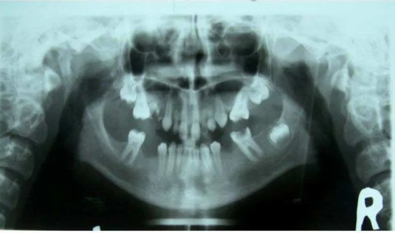 Gambaran radiografi membantu dalam menegakkan diagnosis EEC 