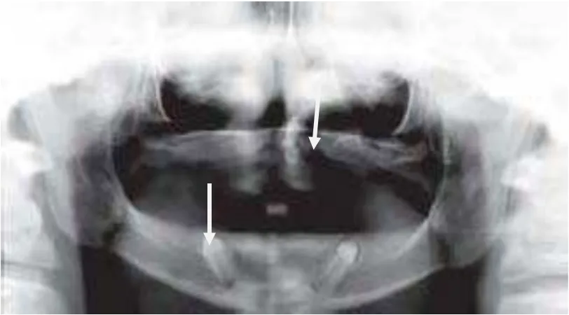 Gambar 7.  Gambaran panoramik  penderita EEC  Syndrome                   terlihat  pada seorang perempuan berusia 18 tahun    partial  anodontia dan akar gigi yang pendek.14   
