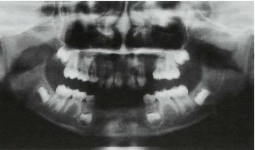 Gambar 9.                    tahun dimana terdapat hipodonsiaGambaran panoramik penderita EEC  Syndrome pada seorang anak perempuan berusia 6 .16  