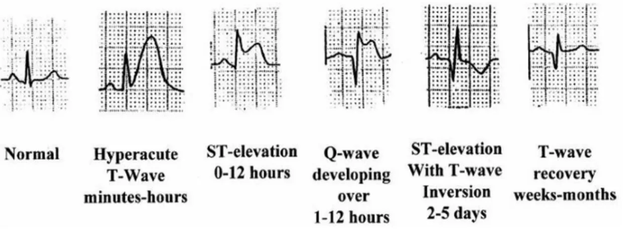 Gambar 10.  Pola perubahan EKG pada IMA dengan ST elevasi (Emerg Med  Clin N Am 2006; 24:53-89)