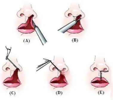 Gambar 3. Reparasi labioschisis (labioplasti). (A and B) pemotongan sudut celah  pada bibir dan hidung