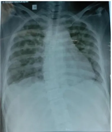 Gambar 1.   X-Ray thorak pasien, menunjukkan  kesan penumonia tipikal karena infeksi virus 