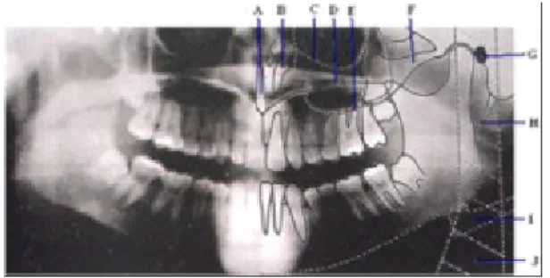 Gambar : Bayangan hard tissues pada radiografi panoramik (Whaites, 1997)