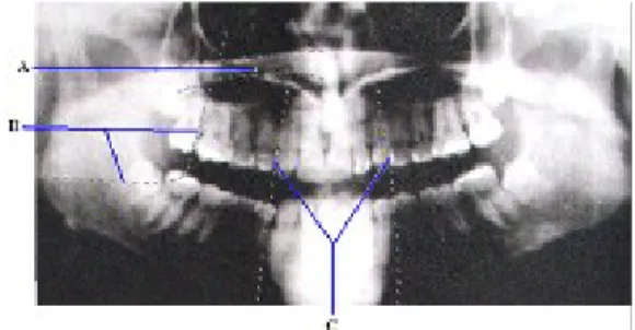 Gambar : Bayangan artefak pada radiografi panoramik (Whaites, 1997) Keterangan :  A. Palate; B