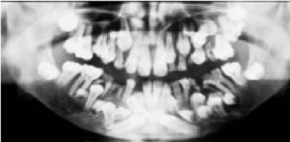 Gambar : Panoramic radiograph of Supernumerary Teeth