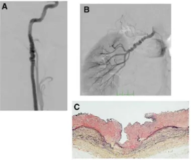 Gambar 1. Gambaran arteriografi pada multifocal fibromuscular  dysplasia pada distal arteri carotis interna (A) dan renalis (B)  berdasarkan klasifikasi American Heart Association