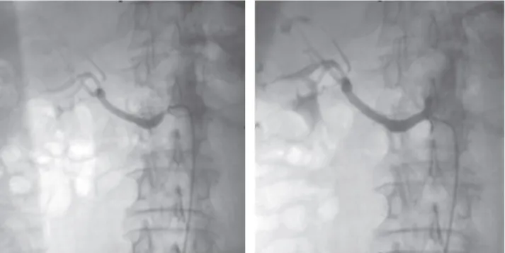 Gambar 2. Angiogram ginjal. (Gambar Kiri) Stenosis ostial arteri renalis kanan yang berat