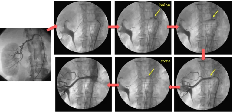 Gambar 5. Tahapan PTRA dengan pengembangan balon dan pemasangan stent.