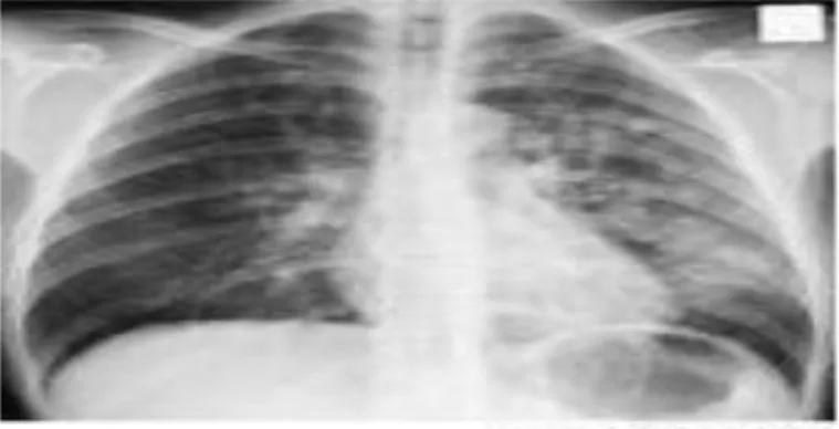 Gambar 2. Bronchopneumonia pada Anak umur 5 tahun 