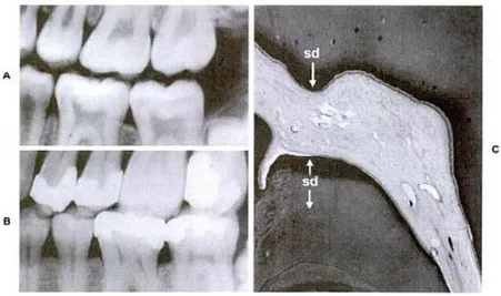 Gambar 4. Perubahan radiografik pada kamar pulpa. 