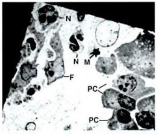 Gambar 5. Sel-sel yang terlihat pada inflamasi pulpa. 