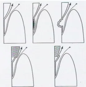 Gambar 3. Deteksi kehalusan (atas kanan) atau iregularitas  pada permukaan akar dengan pergerakan probe atau eksplorer 