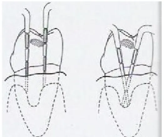 Gambar 6. Insersi probe secara vertikal (kiri) tidak mendeteksi interdental crater; probe dengan posisi oblique (kanan) 