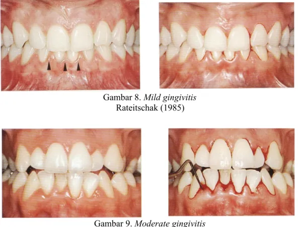 Gambar 8. Mild gingivitis Rateitschak (1985)