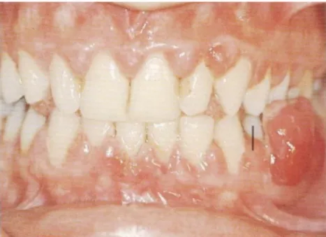 Gambar 12. Severe pregnancy gingivitis with epulis Rateitschak dkk (1985)