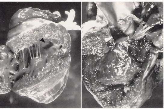 Gambar kiri : jantung dilihat dari sisi kanan; hipertropi ventrikel kanan, cacat sekat ventrikel 