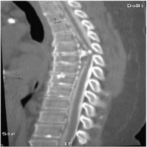 Gambar  9.  Potongan  sagital  myelogram  CT  menunjukkan,  besar  kalsifikasi,  ekstrusi  diskus  posterior  menyebabkan  kompresi  spinal  yang  parah di tingkat T5-6 