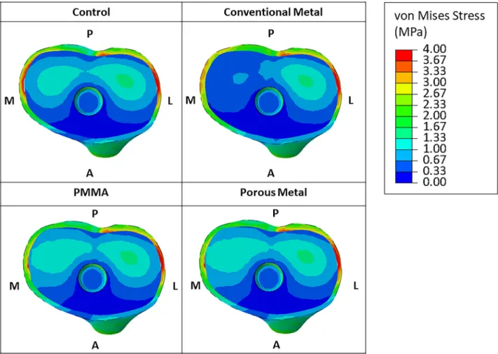 Fig. 3 Graphical overview of the von Mises stress in the tibial-bone interface for all the considered material models in the case of an augment of 5 mm
