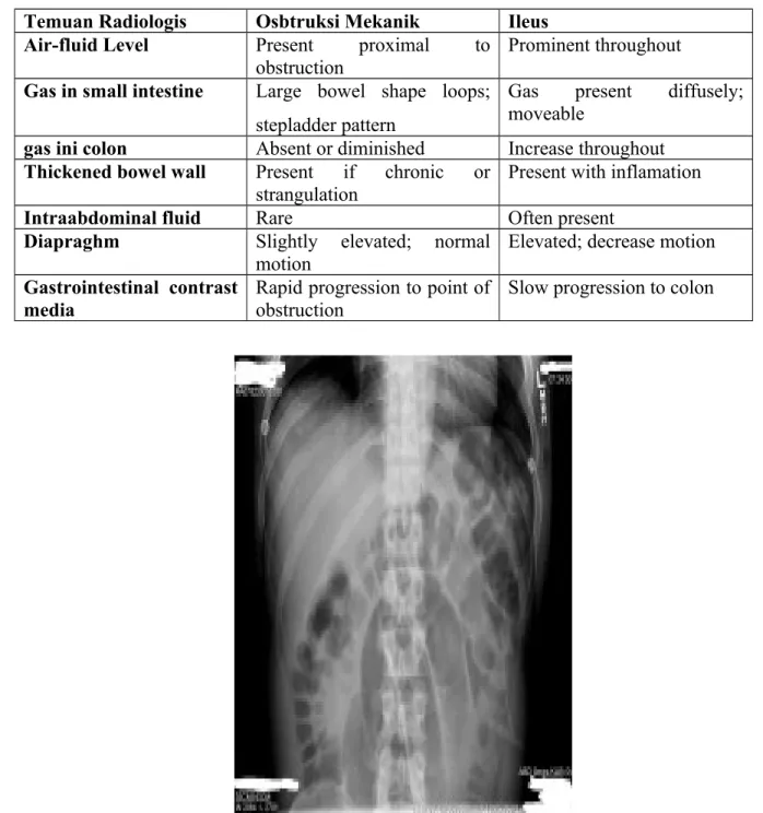 Tabel 2.4 Perbedaan Radiologi obstruksi intestinal dan ileus Temuan Radiologis Osbtruksi Mekanik Ileus