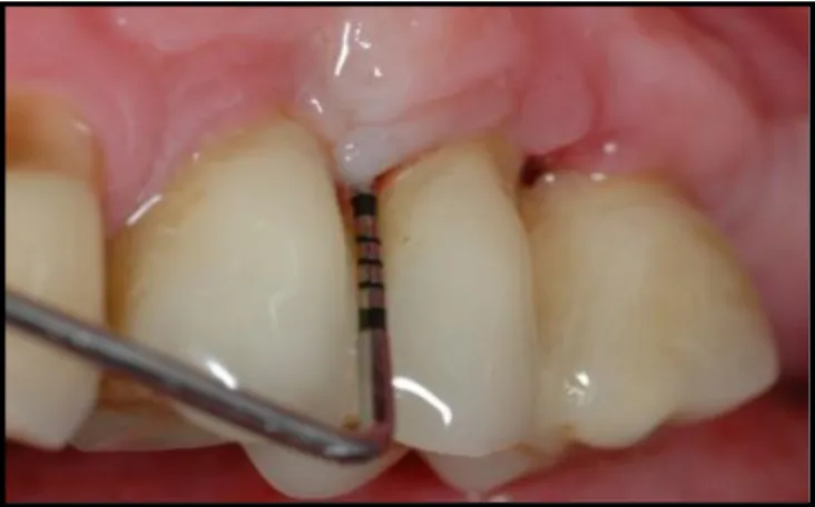 Tabel 3. Indeks gingiva (Loe dan Silness) 24,48,50
