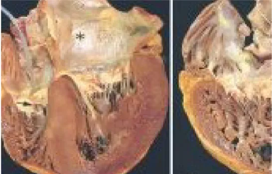 Gambar 2.2 Left Ventricle Hypertrophy  pada penyakit jantung hipertensi           Darah   dapat   beredar   melewati   arteri   koroner   saat diastol   karena   darah   tersebut   tertekan   saat   sistol