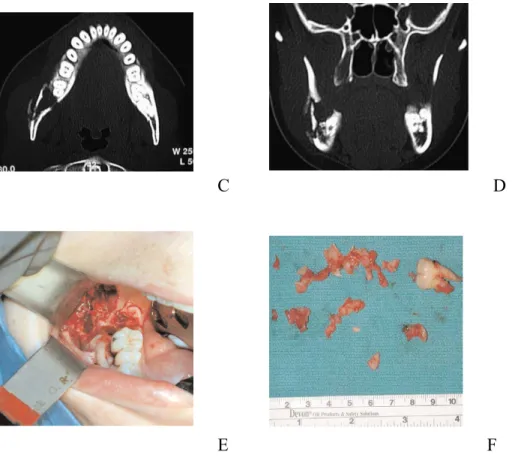 FIGURE 17-2 A, Panoramic view of extraction site of tooth no. 32 in an otherwise healthy 32-year-old patient