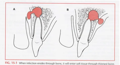 Gambar di bawah menunjukkan bagaimana infeksi yang mengalami perforasi  melewati tulang sampai jaringan lunak