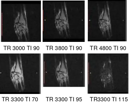 Tabel 3. Pengaruh variasi nilai Time Repetitioninformasi anatomi dengan nilai  terhadap nilai Time Inversion diatur tetap (90 ms) 