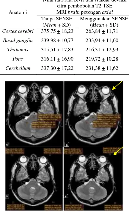 Tabel 2. Hasil uji normalitas data nilai SNR secara keseluruhan citra pembobotan T2 TSE MRI brain potongan axial antara penggunaan SENSE dengan tanpa SENSE 
