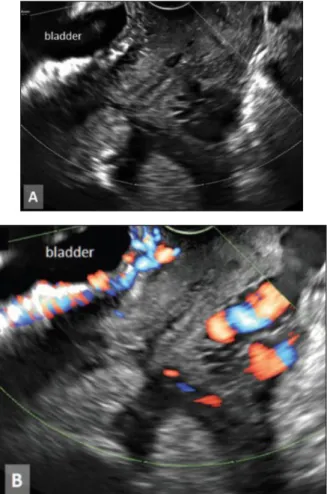 Gambar 8. A. Penebalan dan iregularitas dari garis antara kandung kemih dan serosa uterus pada kehamilan dengan plasenta previa