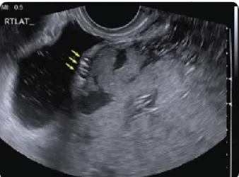 Gambar 2. Tanda panah Panah menunjuk gambaran dot and dash echogenic  uterus-kandung kemih tampak depan