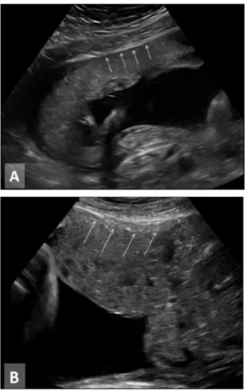 Gambar   7.   A.   Zona   retroplasenta   hipoekhoik   normal (panah) antara plasenta dan dinding uterus