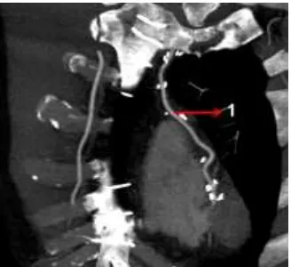Gambar 4. Hasil VRT CT  dari pertengahan anterior ascendens aorta proksimal dihubungkan ke anterior ascendens aorta proksimal dihubungkan ke marginal branch proximal diagonal branch 4)  CABG 4 berasal dari dari pertengahan subclavia proximal (LMA graft) yang dihubungkan ke bagian distal aorta ascenden dihubungkan ke distal RCA 3) CABG 3 berasal dari (OM)  5) CABG 5 berasal dari dari pertengahan anterior ascendens LAD 2)  CABG 2 berasal dari vena sapheneous dari anterior kanan Cardiac 1) CABG 1 berasal dari artery aorta proksimal dihubungkan ke distal dari LCx  