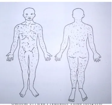 Gambar 3. Area Predileksi Tinea Korporis