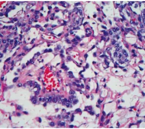 Gambar 2.4. Endodermal sinus tumor ovarium. Terdapat Schiller-Duval body  dengan vena sentralnya dan lapisan endoderm