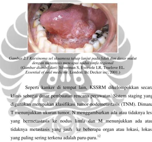 Gambar 2.1 Karsinoma sel skuamosa tahap lanjut pada lidah dan dasar mulut  dengan metastasis mencapai nodus limfa regional 