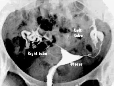 Gambar 10. Gambar histerosalpingogram normal. Sebuah rongga halus segitiga rahim dan tumpahan dari kedua tabung