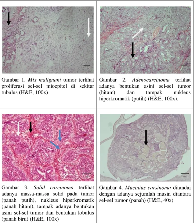 Gambar  1.  Mix  malignant  tumor  terlihat  proliferasi  sel-sel  mioepitel  di  sekitar  tubulus (H&amp;E, 100x) 