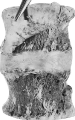 Gambar 2.1 Korpus vertebra lumbal 3 dan 4 , terdapat serabut  spiral pada lamela  Perlekatan periosteum dari ligamen longitudinal anterior terlihat dengan jelas