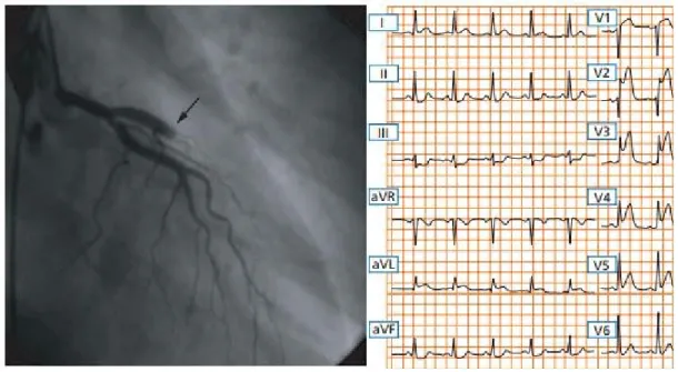 Gambar 10.EKG STEMI Anterior  6