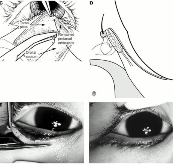 Gambar 4. Operasi dengan perbaikan faisa kapsulopalpebra dengan teknik  inferior refraktorplication