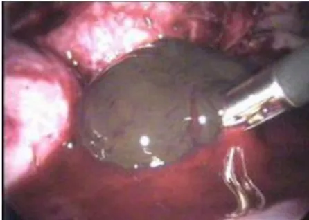 Gambar 9 :Kista Endometroid  e.  Kista Dermoid 