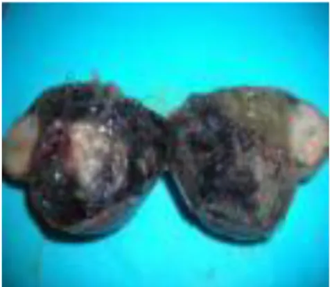 Gambar 10 : Kista Dermoid  2.  Solid 