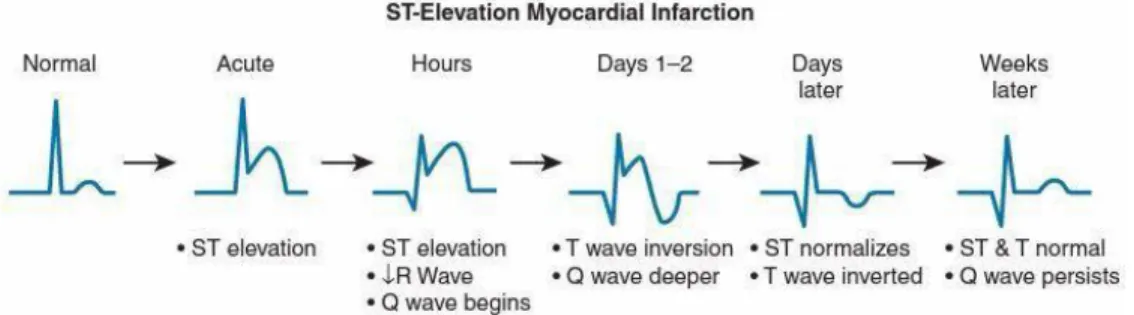 Gambar 2.2 ST-Elevasi Miokard Infark  13  2.9.4 Biomarker 