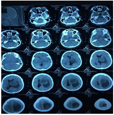 Gambar 1. CT-Scan kepala pasien 