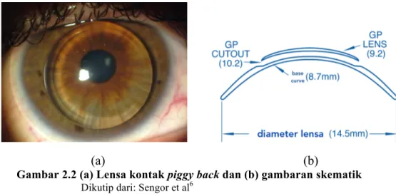 Gambar 2.2 (a) Lensa kontak piggy back dan (b) gambaran skematik      Dikutip dari: Sengor et al 6