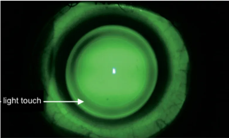 Gambar 3.3 Pola fluorescein apical clearance dengan light touch  Dikutip dari : Rubinstein et al 8